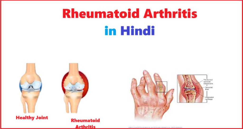 Rheumatoid Arthritis in Hindi