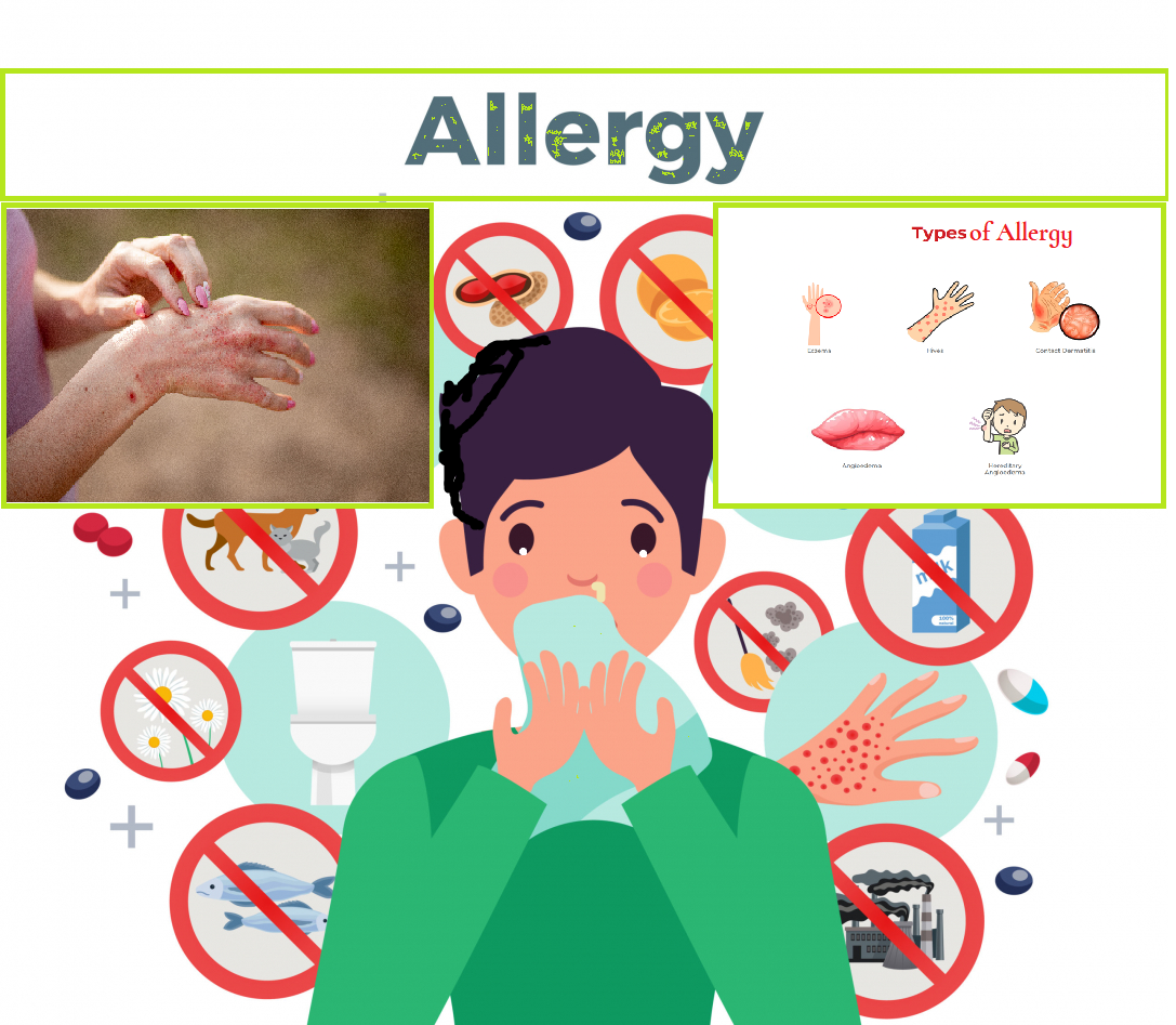 Allergy : एलर्जी के कारण, लक्षण, रोकथाम और प्राकृतिक उपचार, जिसमें आयुर्वेदिक उपचार