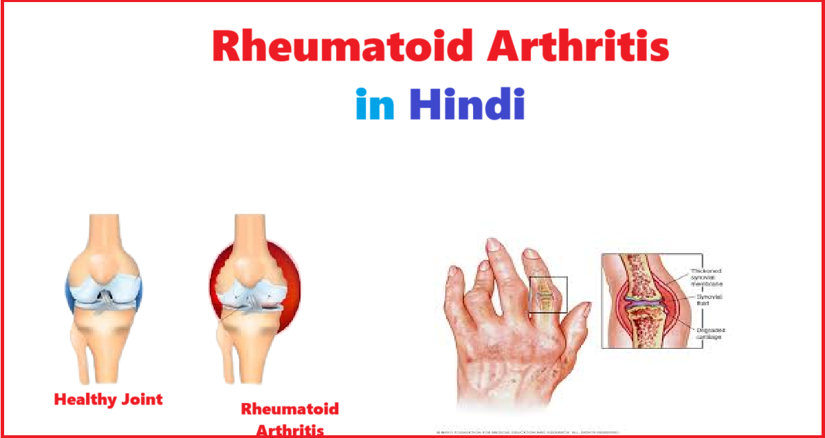 Rheumatoid Arthritis in Hindi